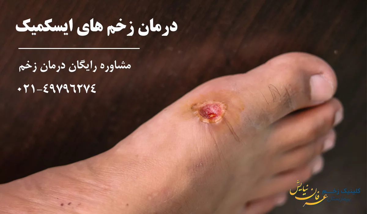 بهترین کلینیک درمان زخم ایسکمیک
