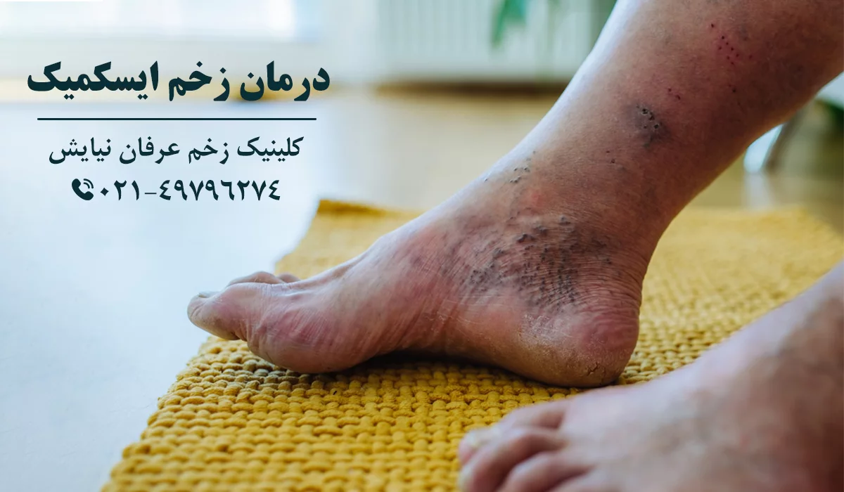 درمان زخم ایسکمیک