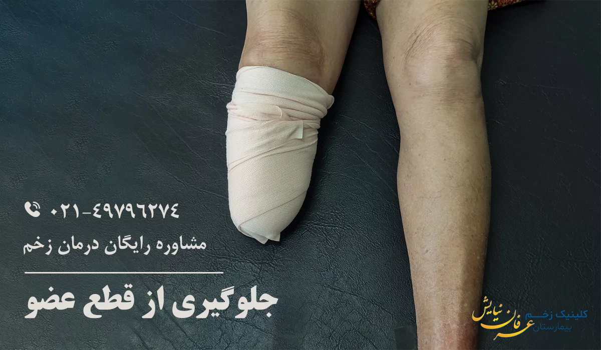 جلوگیری از قطع عضو