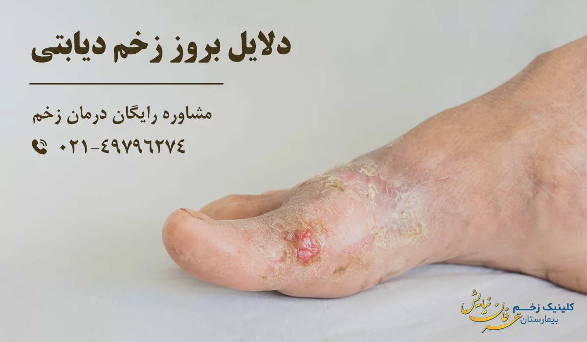 دلایل بروز زخم دیابتی