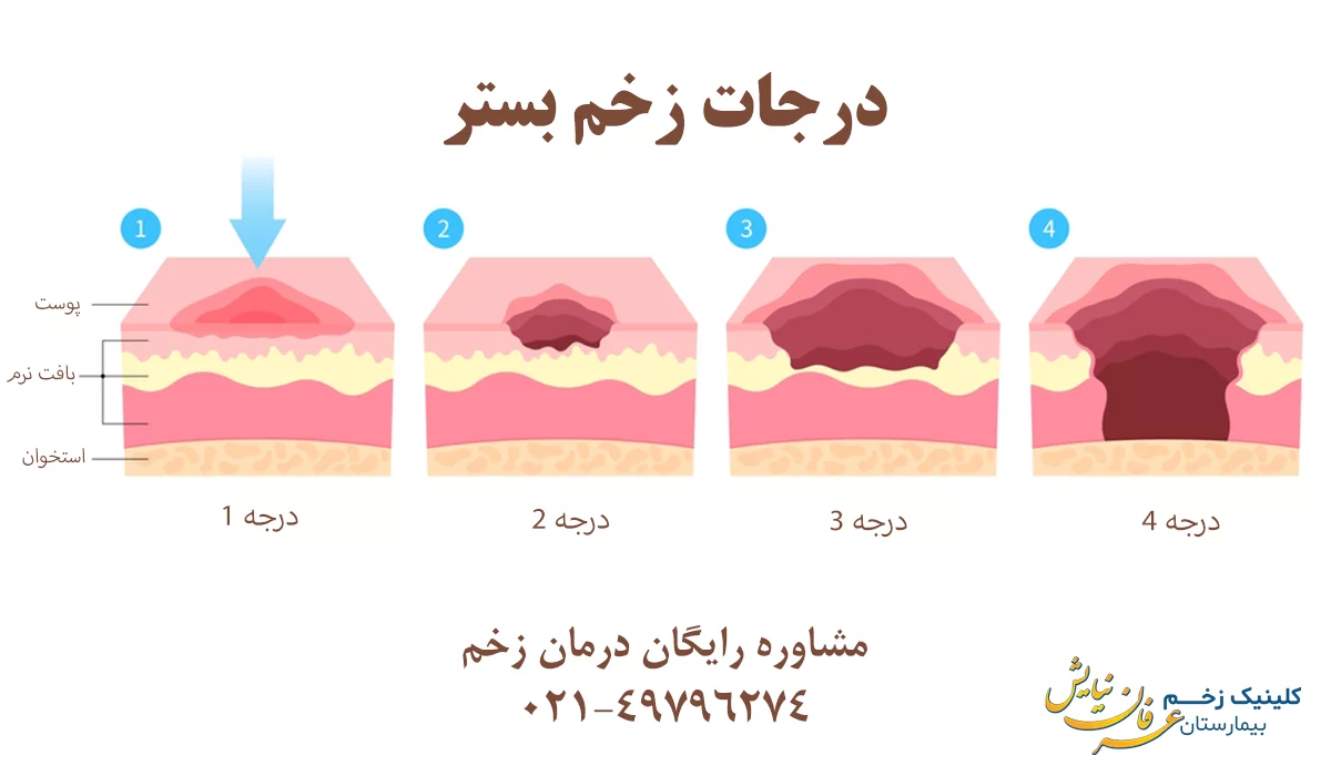 انواع زخم بستر (درجات زخم بستر)