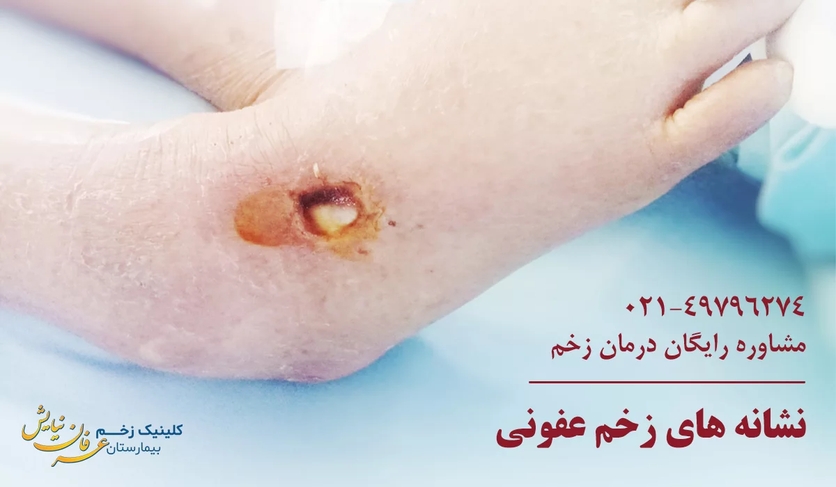 علائم عفونت زخم