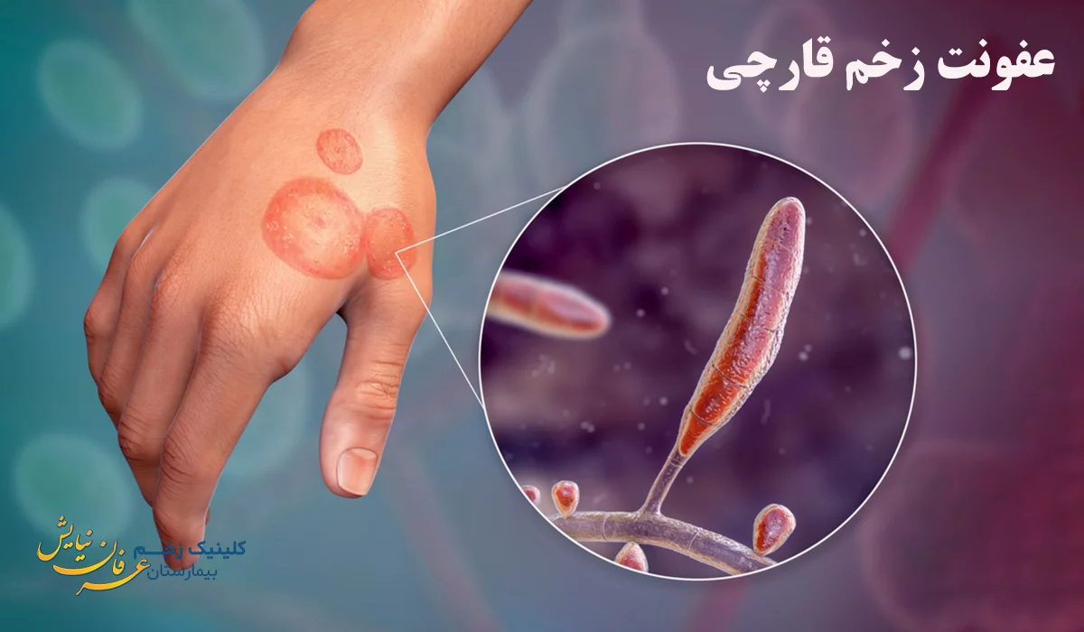 عفونت زخم قارچی