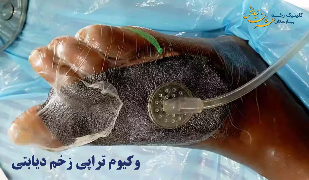 وکیوم تراپی زخم پای دیابتی