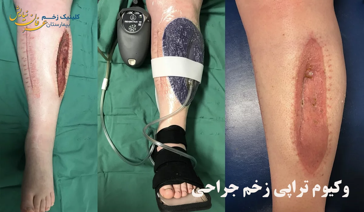 وکیوم تراپی زخم جراحی