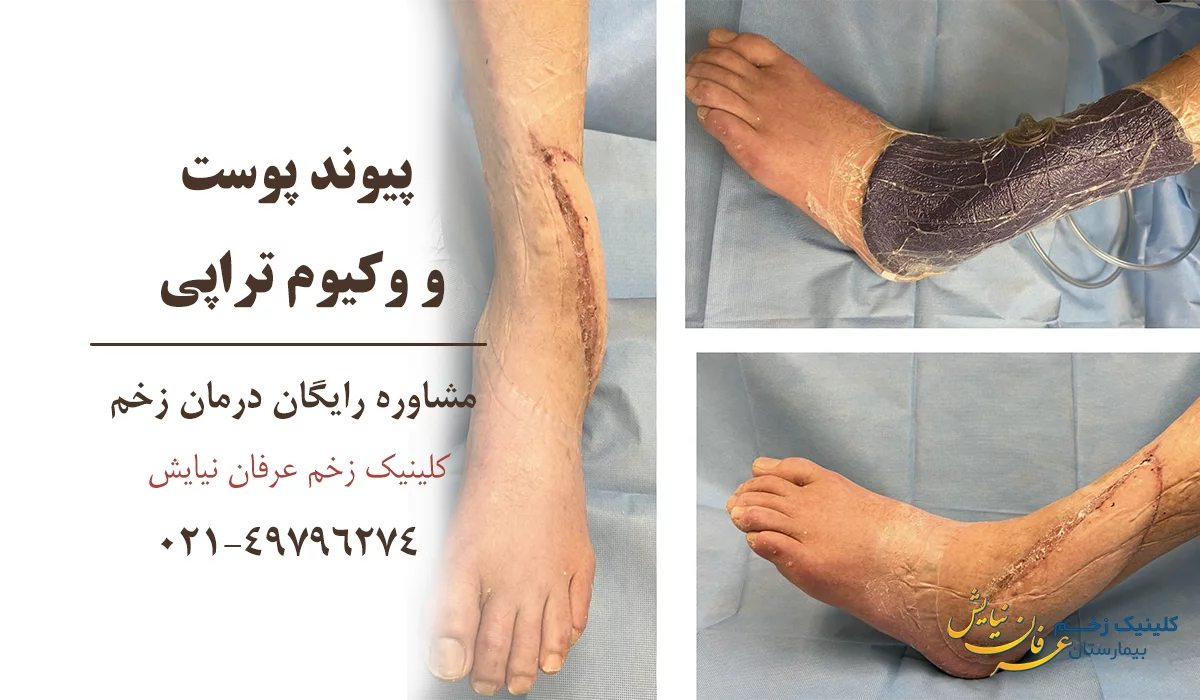 وکیوم تراپی زخم و پیوند پوست