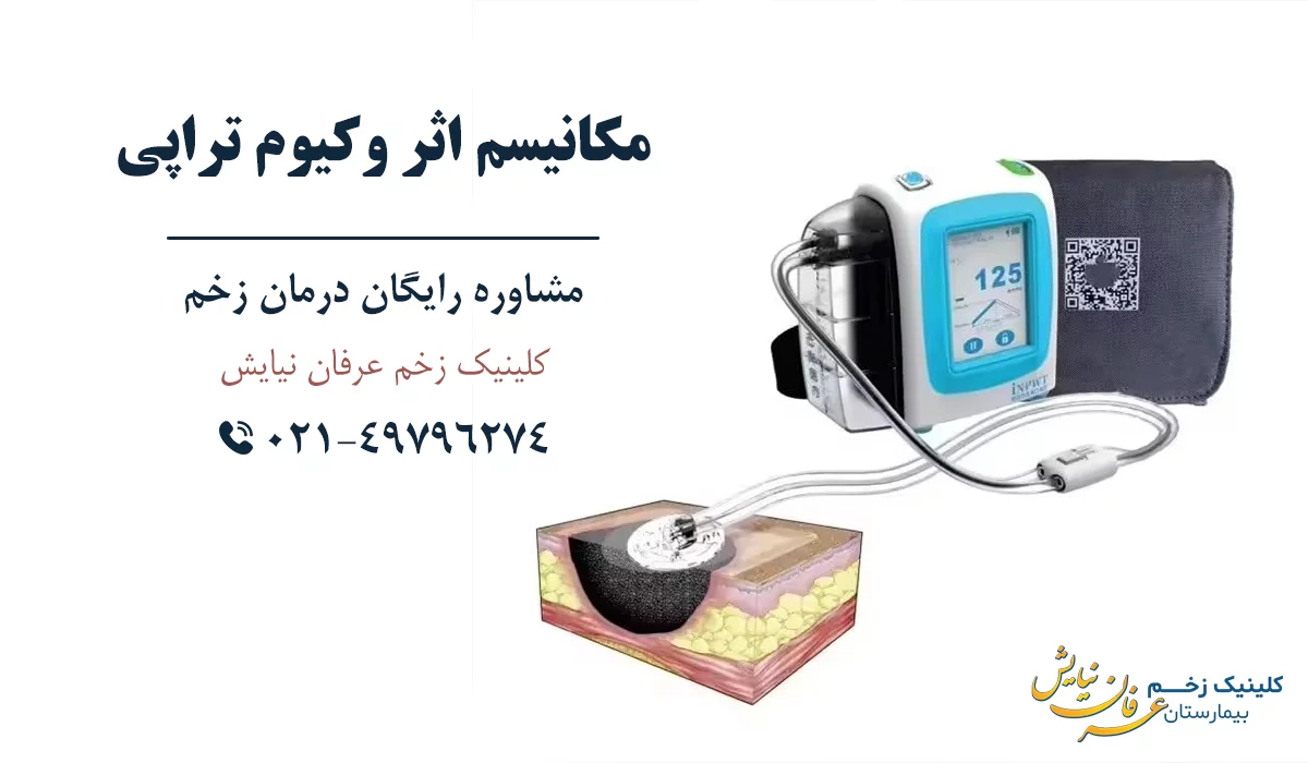 مکانیسم اثر وکیوم تراپی زخم