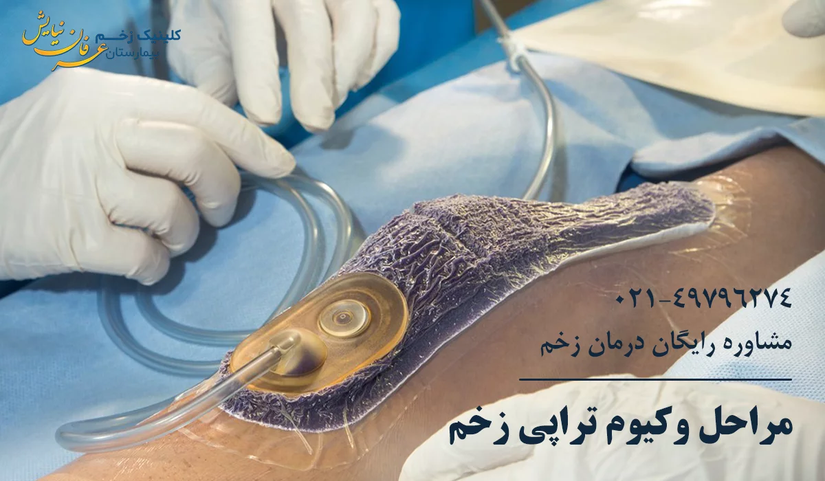 مراحل انجام وکیوم تراپی زخم