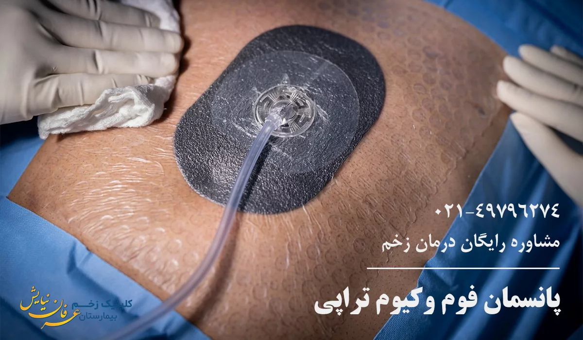 پانسمان وکیوم تراپی زخم