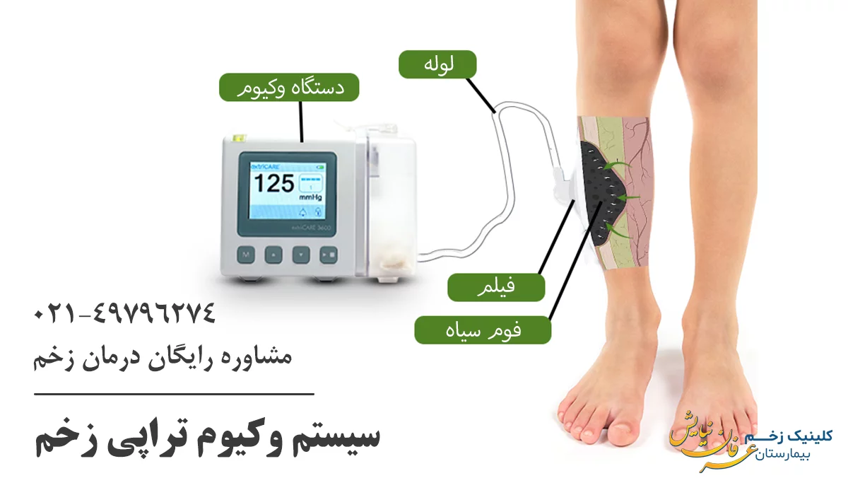 وکیوم تراپی زخم