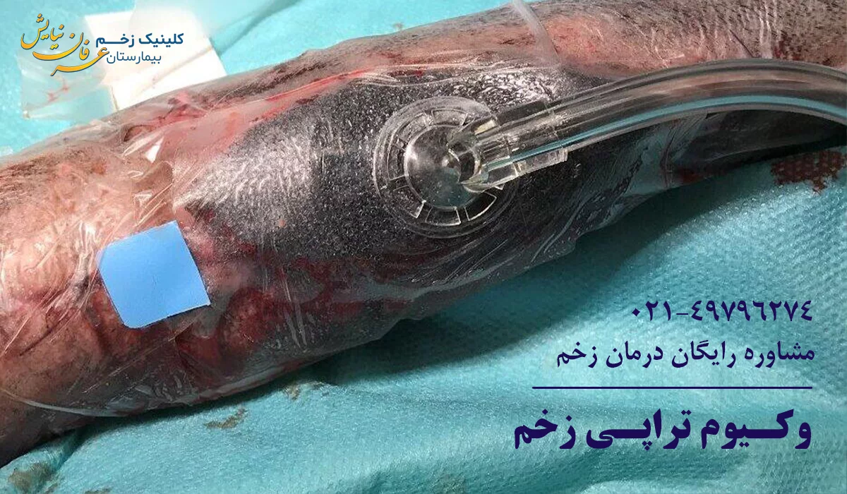 وکیوم تراپی زخم