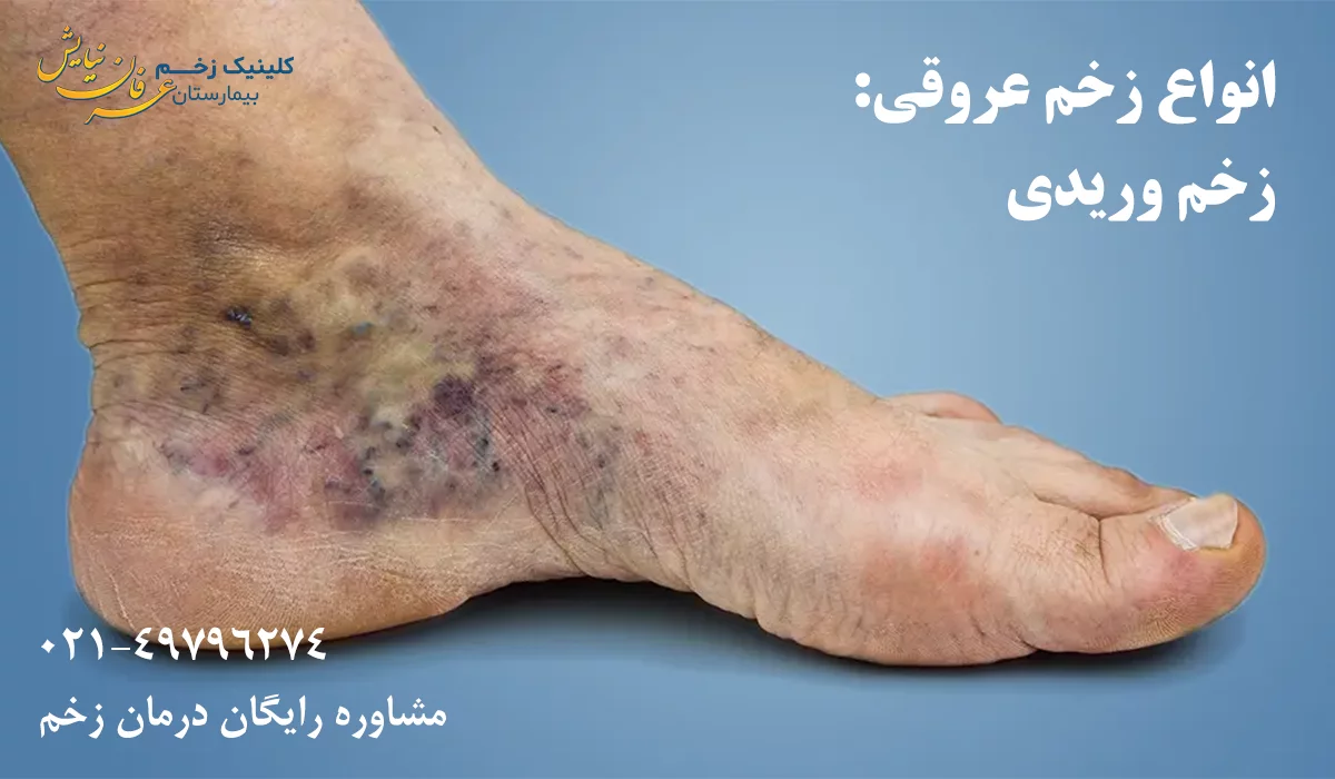 زخم عروقی وریدی