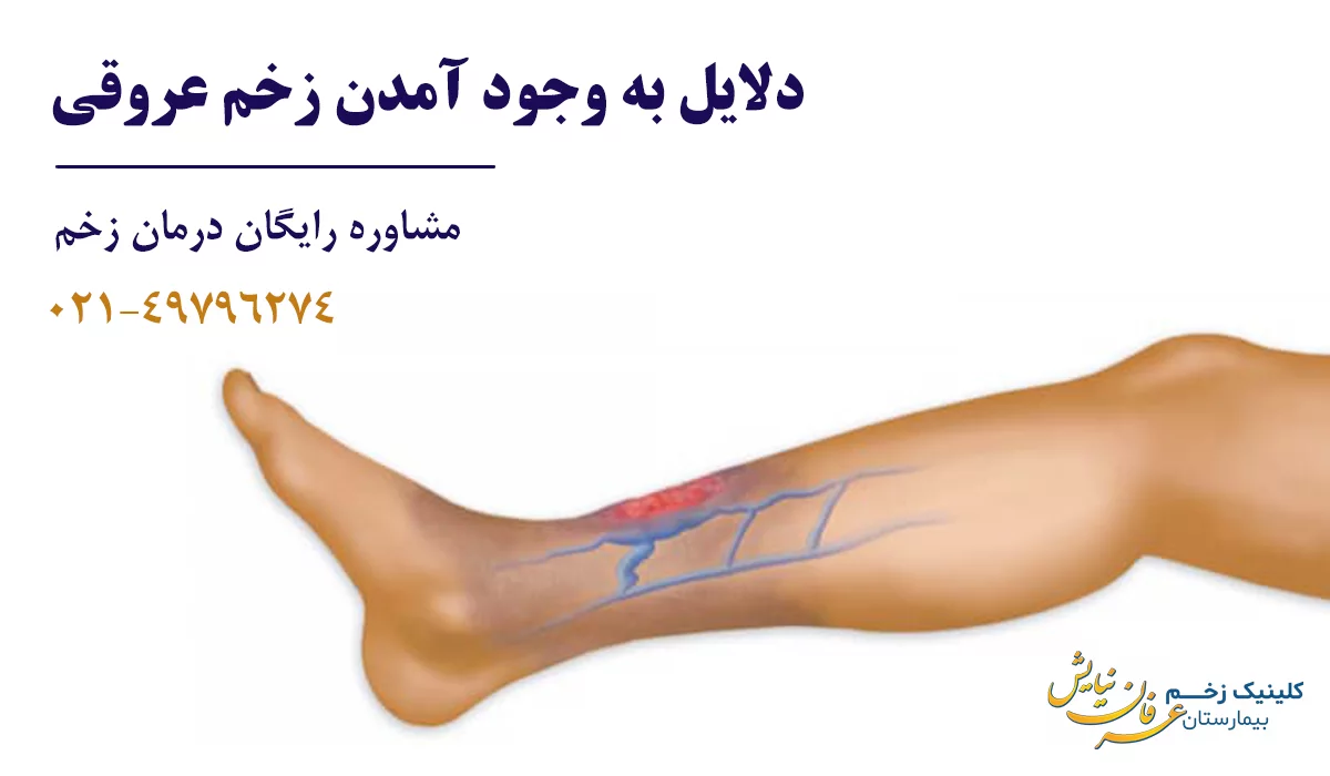 دلایل زخم عروقی