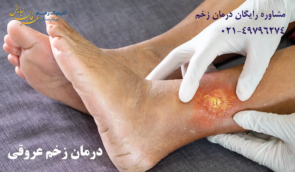 درمان زخم عروقی