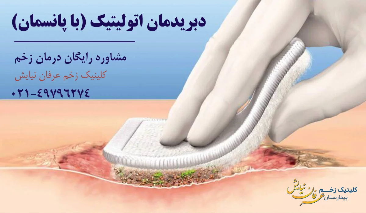 دبریدمان زخم اتولیتیک