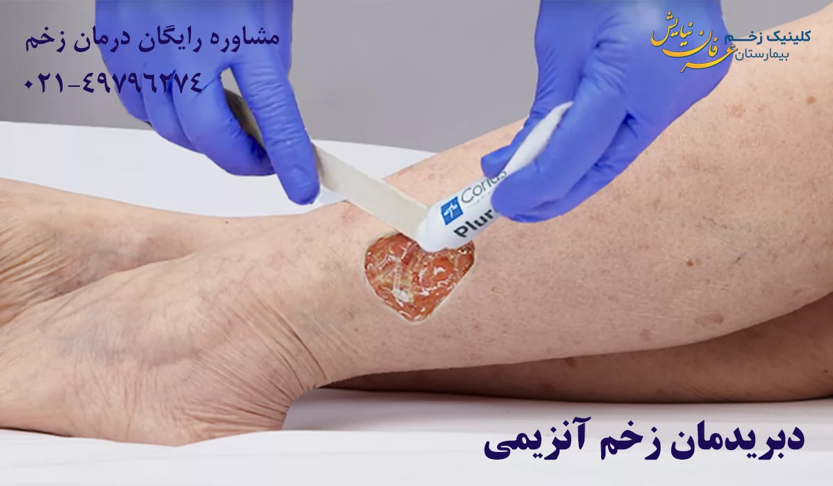 دبریدمان زخم آنزیمی