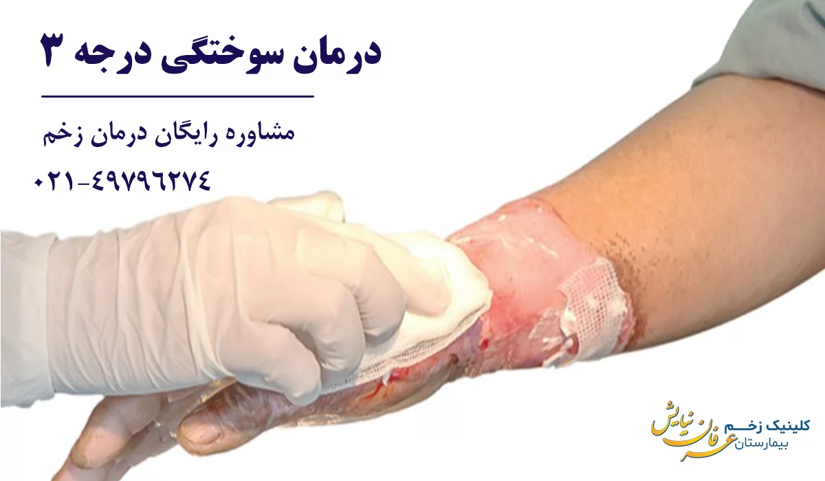درمان سوختگی درجه 3