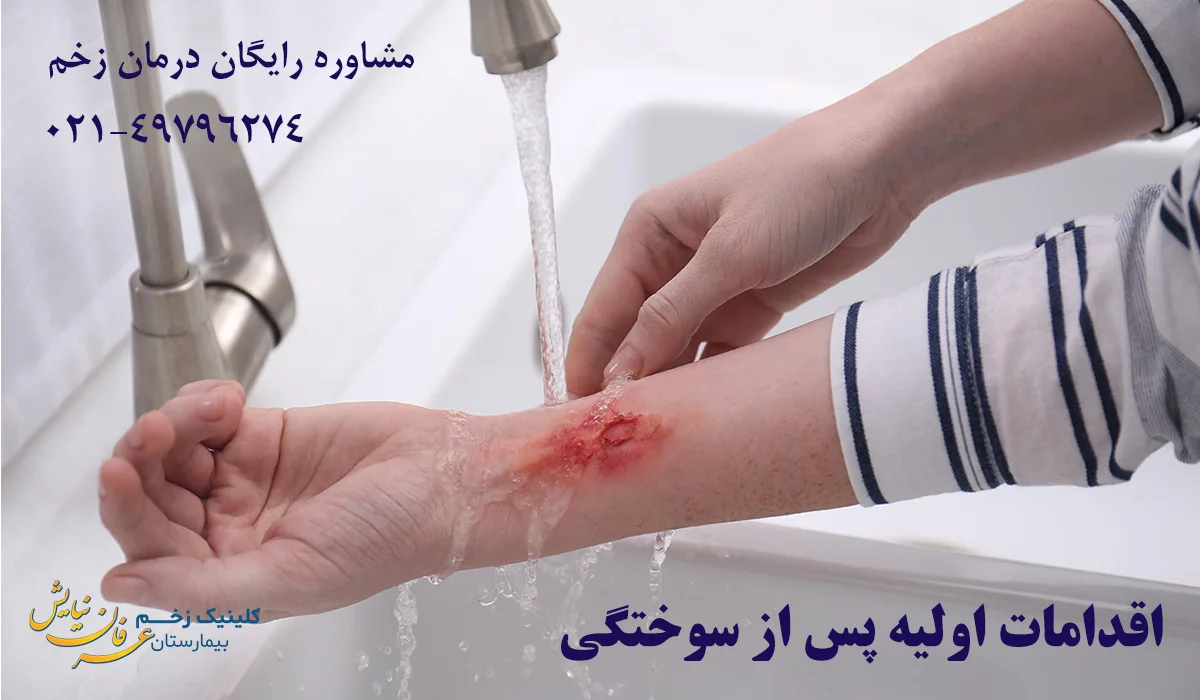 اقدامات اولیه درمان سوختگی