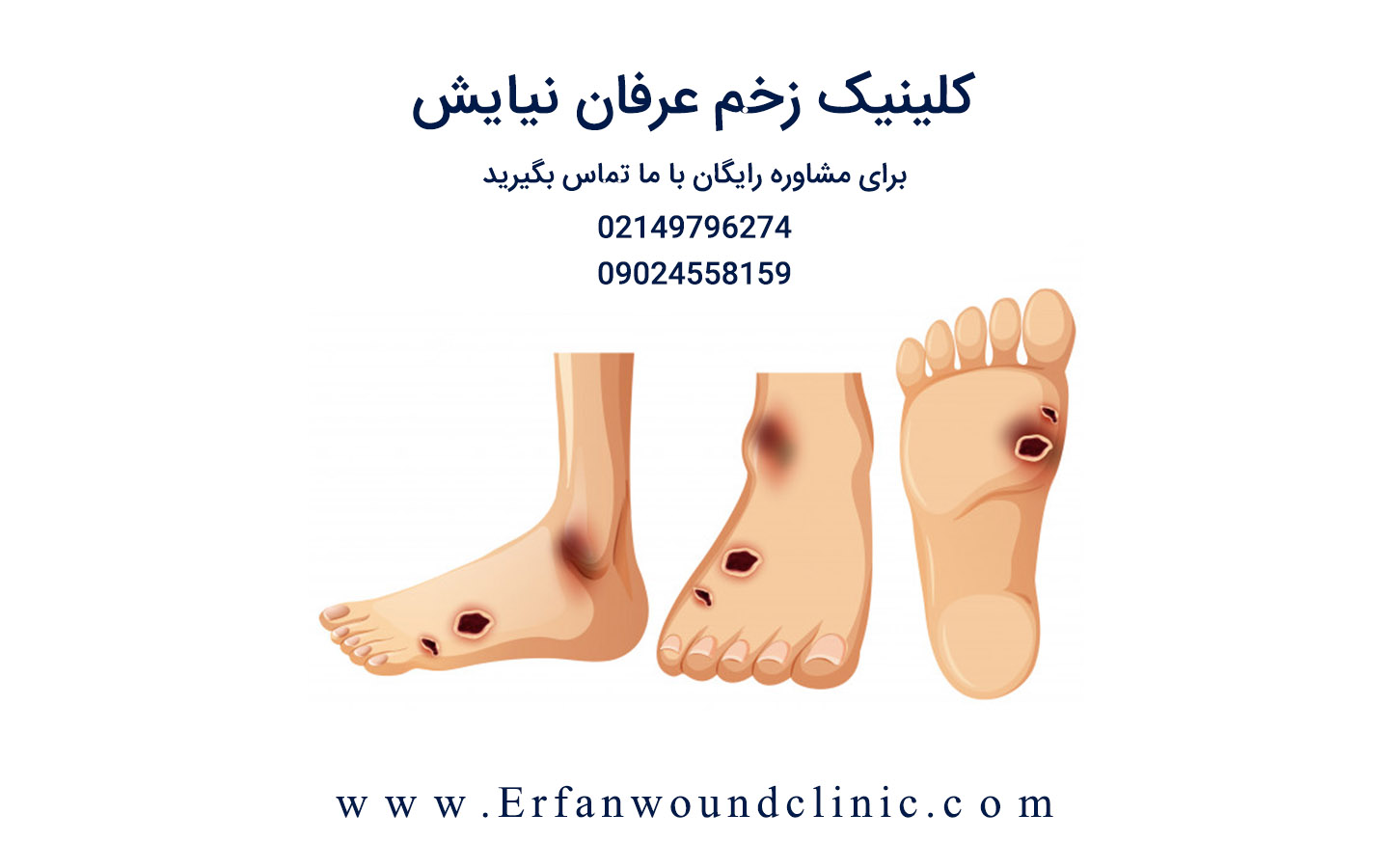زخم پا دیابتی